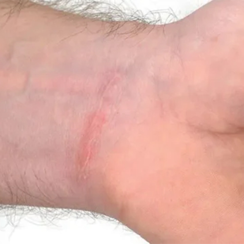 Närbild av en handled med ett rodnat ärr, fotograferad för skadeärenden till försäkringsärenden i Varberg.